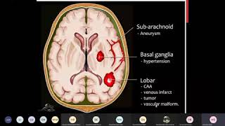 Pathology of cerebrovascular diseases  intraparenchymal heamorrhage1 [upl. by Eimmot]