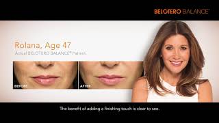 BELOTERO BALANCE  Dermal Filler [upl. by Val]