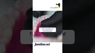 Procedure of Fixed Retainer dentist bracing fixedretainerRetainerOrthodonticsRetention [upl. by Hna]