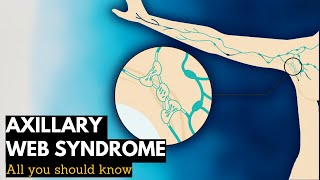 Axillary Web Syndrome Everything You Need To Know [upl. by Africah648]