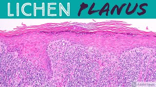 Lichen Planus amp Hypertrophic Lichen Planus Inflammatory Dermpath 101 for Dermatology amp Pathology [upl. by Ohcamac]