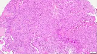 Ependymoma explained  Adventures in Neuropathology [upl. by Marashio117]