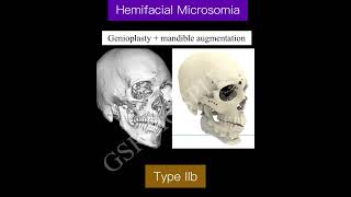 Hemifacial Microsomia Type IIb  Surgery at GSRHospital [upl. by Woodman]