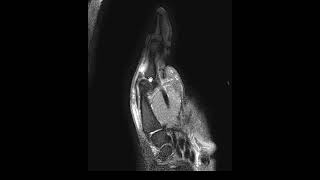 Extensor pollicis longus tendon tear [upl. by Lamraj]