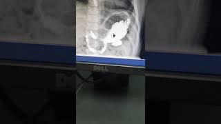 Serie Esófago Gastro Duodenal SEGD en Niños [upl. by Gosnell]