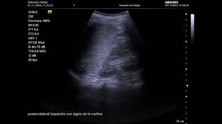 Video FAST posterolateral izquierdo [upl. by Danice]