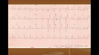 Hyperkalemia Treatment and ECG Changes [upl. by Geis]