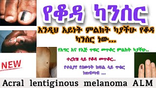 Acral lentiginous melanoma ALM  የቆዳ ካንሰር  የጤና ቃል [upl. by Ahsinoj]