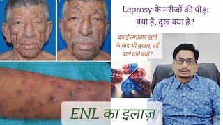 Leprosy  Erythema Nodosum Leprosum  दवाई लगातार खाने के बाद भी बुखार दर्द वाले दाने क्यों ENL [upl. by Maryellen561]