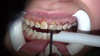 Gingivectomy in aesthetic zone Gummy smile treatment Cosmetic Dentistry Los Angeles 8187760055 [upl. by Subir924]