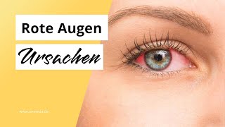 Rote Augen Erkrankungen als Ursache [upl. by Silin394]