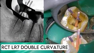 Live Root Canal treatment Double curvature [upl. by Thorner354]