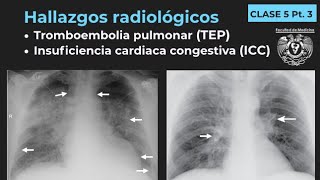 053 Tromboembolia pulmonar e Insuficiencia cardiaca congestiva Tórax Pt 2 [upl. by Lathe619]