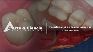 ►Incrustaciones de Resina Indirectas  Dr Ivan Vera Vélez [upl. by Kelcie819]