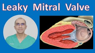 Leaky Mitral Valve  Mitral Valve Regurgitation [upl. by Ateloiv]