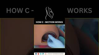 Cesarean Section Explained Why Doctors Choose CSections for a Safer Birth 👶✂️ Cesarean Birth [upl. by Lillith]