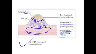 keratoacanthoma [upl. by Adnamas]