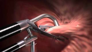 ROSE procedure  bariatric surgery revision [upl. by Intirb]