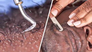 Ingrown Hair Treatment [upl. by Alveta]