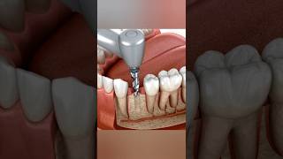 How Do Dental Implants Work 🦷😬 [upl. by Ulric]