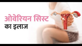 Benign Ovarian Cyst  बिनाइन ओवेरियन सिस्ट क्या होता है  Its Symptoms And Treatment [upl. by Starbuck]