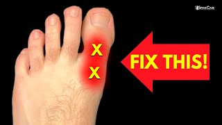 How to Fix BIG TOE Pain for Good [upl. by Fezoj]