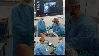 Cirurgia de Varizes a LASER  Equipe Fluxo de Cirurgia Vascular shorts [upl. by Migeon]