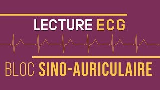 Interprétation ECG  Bloc SinoAuriculaire [upl. by Goldarina851]