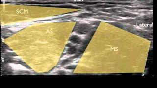 Ultrasound Guided Interscalene Nerve Block [upl. by Chapell]