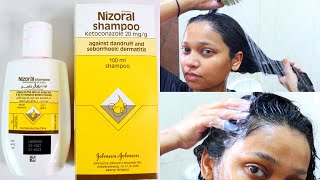 Nizoral Shampoo Against Fungal Acne  Is it Effective [upl. by Thoer]