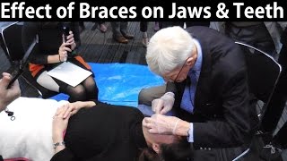 How Do Orthodontic Braces Change Upper amp Lower Jaws Position amp Teeth Misalignment by Prof John Mew [upl. by Upshaw87]