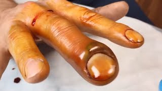 Paronychia PusFilled Infected Nail Treatment Procedure [upl. by Gernhard]