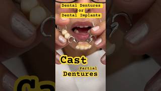 Cast Partial Dentures  Acrylic partial Dentures [upl. by Ambie639]