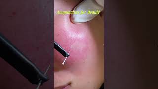 Cosmetic Acupuncture for Beautification health acupuncture viralvideo [upl. by Yduj]