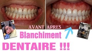 Blanchiment dentaire  AVANTAPRES Revue 25 [upl. by Enyr859]