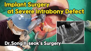 Sub Single Implant Surgery at Large Intrabony Defect [upl. by Wincer]