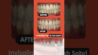 Improve your smile with Invisalign by Dr Ash Sabri [upl. by Aubreir]