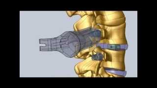 Minimally Invasive Transforaminal Lumbar Interbody Fusion Procedure [upl. by Ynnor]