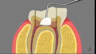 pulpotomy [upl. by Icken941]