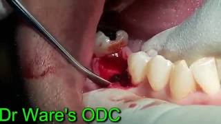 Immediate implant placement in mandibular molar region [upl. by Notsirk124]