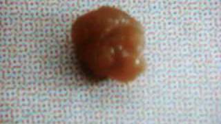 Ureteric stone URIC ACID STONE URETERIC COLIC [upl. by Ettennal]