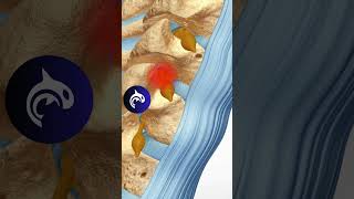 Cervical Selective Nerve Root Block SNRB anatomy orthopedics spine [upl. by Rakso]