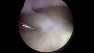 Fragmented medial coronoid process [upl. by Maddie581]