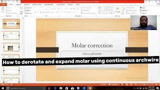 How to do molar derotation and expansion using continuous archwire Toe inToe outbends explained [upl. by Eardnoed]