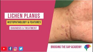 What is Lichen Planus Histopathology amp Features Diagnosis amp Treatment [upl. by Perdita]