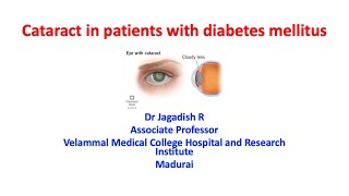 Cataract in diabetes [upl. by Nikolaos870]