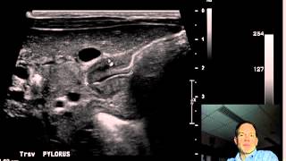 Pyloric Stenosis ULTRASOUND DISCUSSION 2 [upl. by Inaluahek]