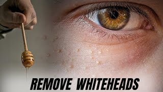 How to Remove Whiteheads from Your Face Naturally [upl. by Jegar]