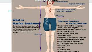 Marfan Syndrome [upl. by Thornton833]