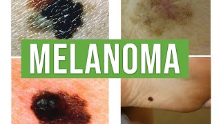 Melanoma vs Benign Melanocytic Nevus  Lecturio Dermatology [upl. by Lucia]